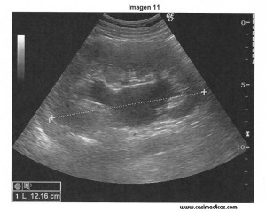 MIR 2013: Urologia (I). Dos preguntas perdidas