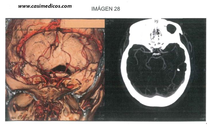 Respuestas NEUROCIRUGIA examen MIR 2017