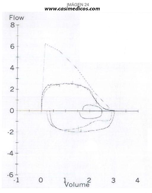Respuestas Neumología y Cirugía Torácica examen MIR 2017