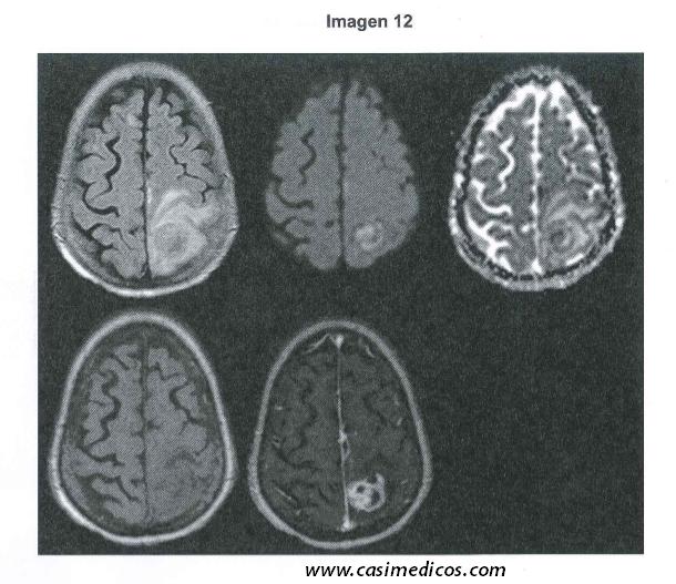 Respuestas Neurología examen MIR 2018