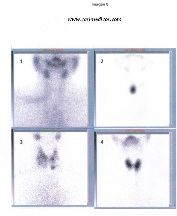 Respuestas Endocrinología examen MIR 2018