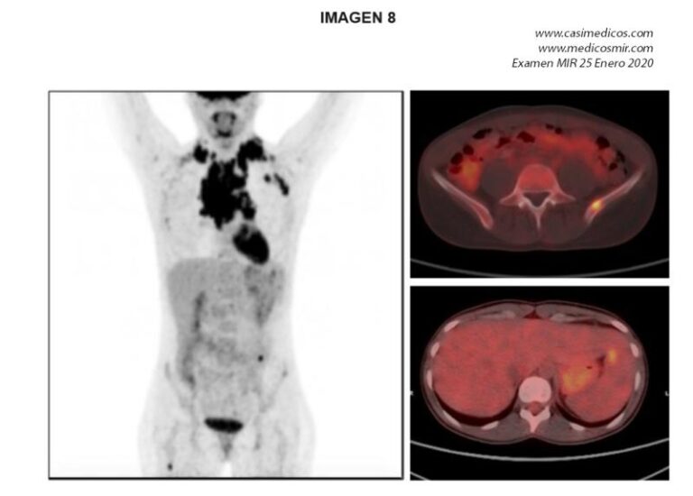 Respuestas comentadas a las preguntas de HEMATOLOGIA del examen MIR 2020
